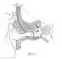 Fig. 02 - Control button configurations for auditory prostheses