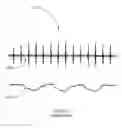 Fig. 15 - Detection and monitoring using high frequency electrogram analysis