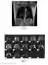 Fig. 14 - Systems, methods, compositions and devices for in vivo magnetic resonance imaging of lungs using perfluorinated gas mixtures