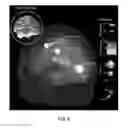 Fig. 08 - ARTIFACT REMOVAL TECHNIQUES WITH SIGNAL RECONSTRUCTION