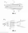 Fig. 05 - IMPLANT WITH SUTURE ANCHOR FIXATION CAPABILITY