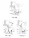Fig. 31 - Enhanced efficacy lung volume reduction devices, methods, and systems