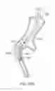 Fig. 49 - Enhanced efficacy lung volume reduction devices, methods, and systems