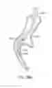 Fig. 50 - Enhanced efficacy lung volume reduction devices, methods, and systems