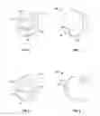 Fig. 05 - Embolization device and a method of using the same