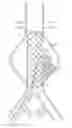 Fig. 01 - Devices and methods for treatment of vascular aneurysms