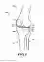 Fig. 04 - Devices and methods for knee replacement