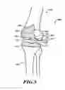 Fig. 05 - Devices and methods for knee replacement