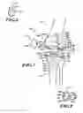 Fig. 06 - Devices and methods for knee replacement