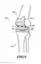 Fig. 07 - Devices and methods for knee replacement