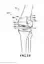 Fig. 08 - Devices and methods for knee replacement