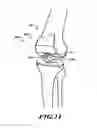 Fig. 09 - Devices and methods for knee replacement