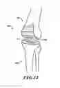 Fig. 10 - Devices and methods for knee replacement