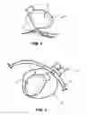 Fig. 04 - Method of amputating and morcellating a uterus