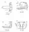 Fig. 04 - Implantation tools for interspinous process spacing device