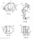 Fig. 05 - Implantation tools for interspinous process spacing device
