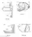 Fig. 06 - Implantation tools for interspinous process spacing device
