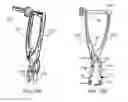 Fig. 27 - Implantation tools for interspinous process spacing device