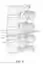 Fig. 05 - Multichannel cannula for kyphoplasty and method of use