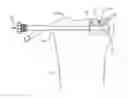 Fig. 01 - Bone fracture reduction device and methods for using same