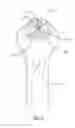 Fig. 05 - Bone fracture reduction device and methods for using same