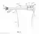 Fig. 06 - Bone fracture reduction device and methods for using same