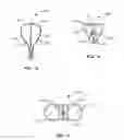 Fig. 08 - Bone fracture reduction device and methods for using same