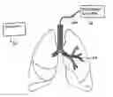 Fig. 01 - METHODS FOR TREATING AIRWAYS