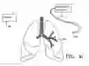 Fig. 05 - METHODS FOR TREATING AIRWAYS