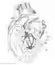Fig. 01 - MYOCARDIAL ABLATION BY IRREVERSIBLE ELECTROPORATION