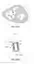 Fig. 28 - MYOCARDIAL ABLATION BY IRREVERSIBLE ELECTROPORATION
