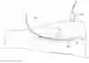 Fig. 01 - Preparation For Endovenous Laser Ablation