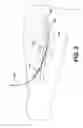 Fig. 03 - Preparation For Endovenous Laser Ablation