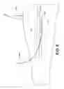 Fig. 10 - Preparation For Endovenous Laser Ablation
