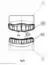 Fig. 05 - ULTRASONIC TOOTH CLEANING APPARATUS AND METHOD