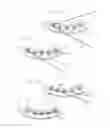 Fig. 04 - Dental prosthesis for cattle
