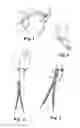 Fig. 02 - IMPLANTS, TOOLS, AND METHODS FOR TREATMENTS OF PELVIC CONDITIONS