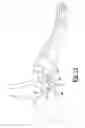 Fig. 10 - Method and apparatus for bone fixation