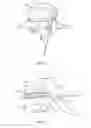 Fig. 07 - SPINAL IMPLANT SYSTEM AND METHOD