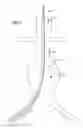 Fig. 07 - Stent graft delivery system with access conduit