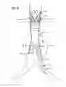 Fig. 10 - Stent graft delivery system with access conduit