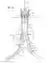 Fig. 11 - Stent graft delivery system with access conduit