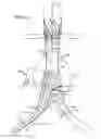 Fig. 13 - Stent graft delivery system with access conduit
