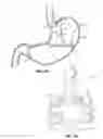 Fig. 02 - Elevating Stomach Stimulation Device