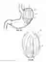 Fig. 06 - Elevating Stomach Stimulation Device