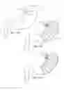 Fig. 17 - Satiation devices and methods