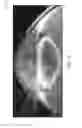 Fig. 14 - SCLERAL TRANSLOCATION ELASTO-MODULATION METHODS AND APPARATUS