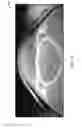 Fig. 15 - SCLERAL TRANSLOCATION ELASTO-MODULATION METHODS AND APPARATUS