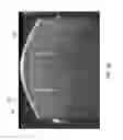 Fig. 23 - SCLERAL TRANSLOCATION ELASTO-MODULATION METHODS AND APPARATUS