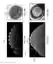 Fig. 24 - SCLERAL TRANSLOCATION ELASTO-MODULATION METHODS AND APPARATUS